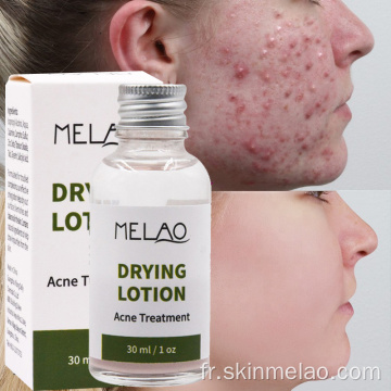 Séchage de la lotion anti-acné sérum de traitement au point